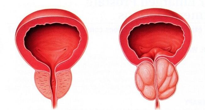 Prostatitis kronikoarekin prostata osasuntsua eta hantura