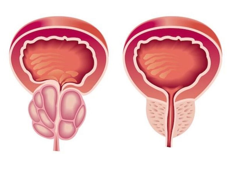 Prostatitis itxura duena